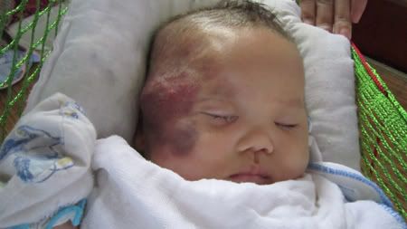 Cầm cự sự sống cho cháu bé 2 tháng tuổi bị u máu trên mặt