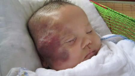 Cầm cự sự sống cho cháu bé 2 tháng tuổi bị u máu trên mặt - 1