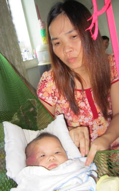 Cầm cự sự sống cho cháu bé 2 tháng tuổi bị u máu trên mặt - 2