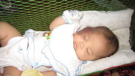 Cầm cự sự sống cho cháu bé 2 tháng tuổi bị u máu trên mặt - 3